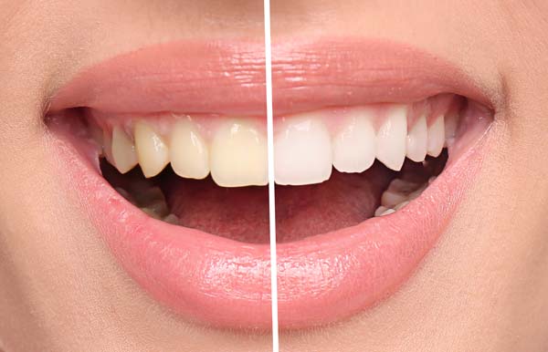 Teeth Whitening Baton Rouge, LA