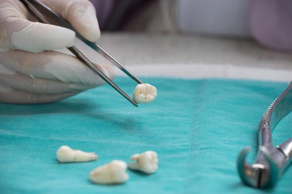 Tooth Extraction Baton Rouge, LA