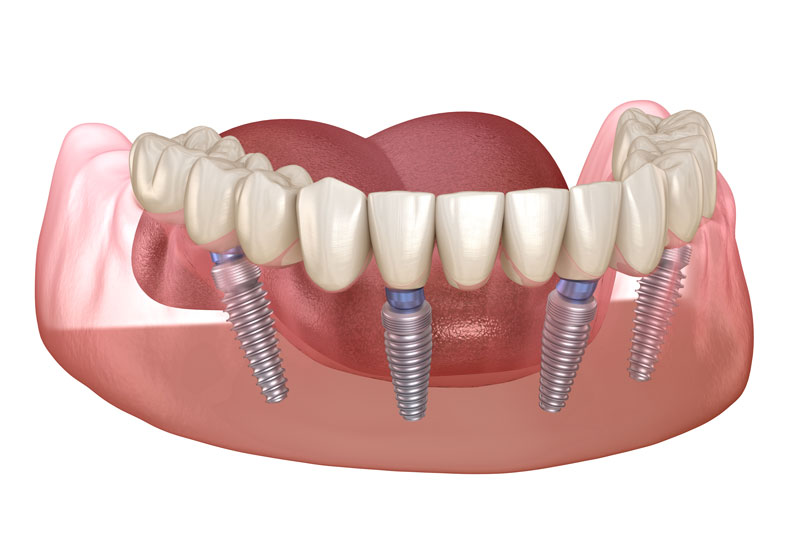 a graphic image of a lower arch All-On-4 dental implant that can be used to restore a patients smile and give them various other benefits.