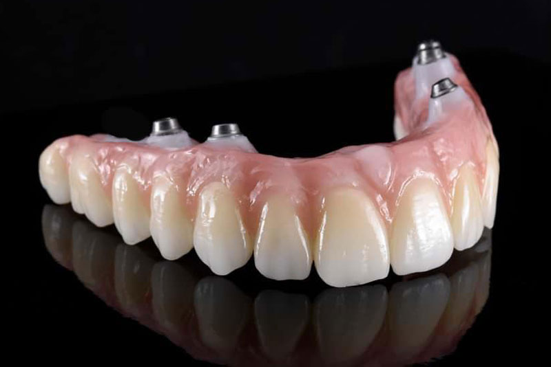 an image of a zirconia bridge of teeth with dental implants in the gums. the zirconia bridge can be used in a zirconia fixed bridge procedure.