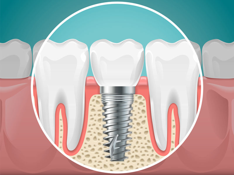 Full Mouth Dental Implants