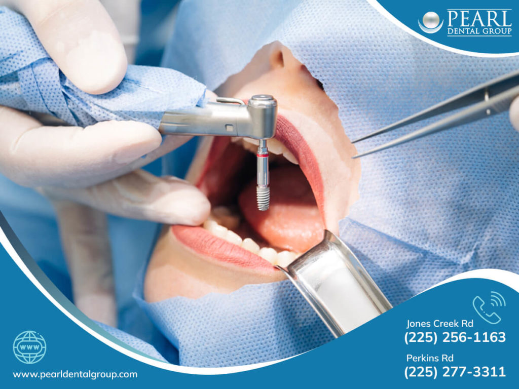 Dental Implants Baton Rouge