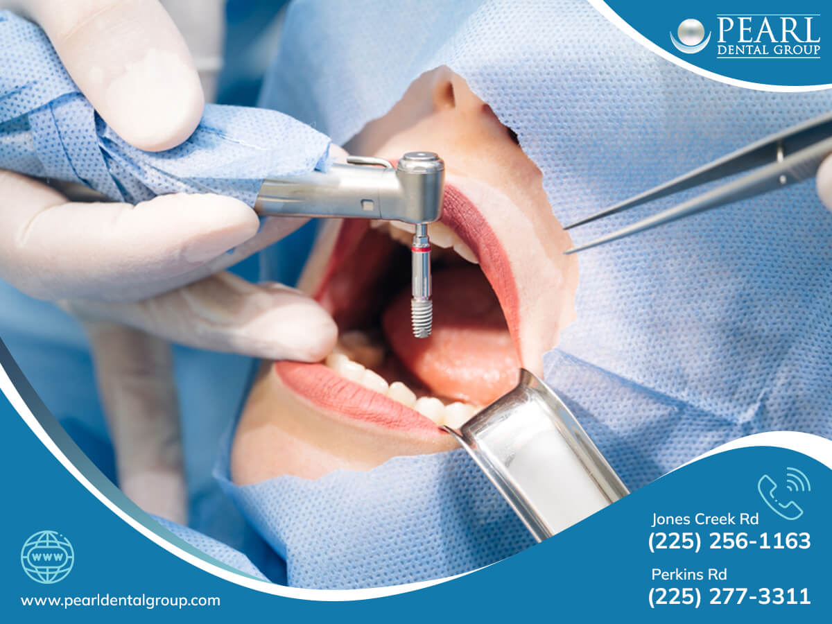 Dental Implants Baton Rouge