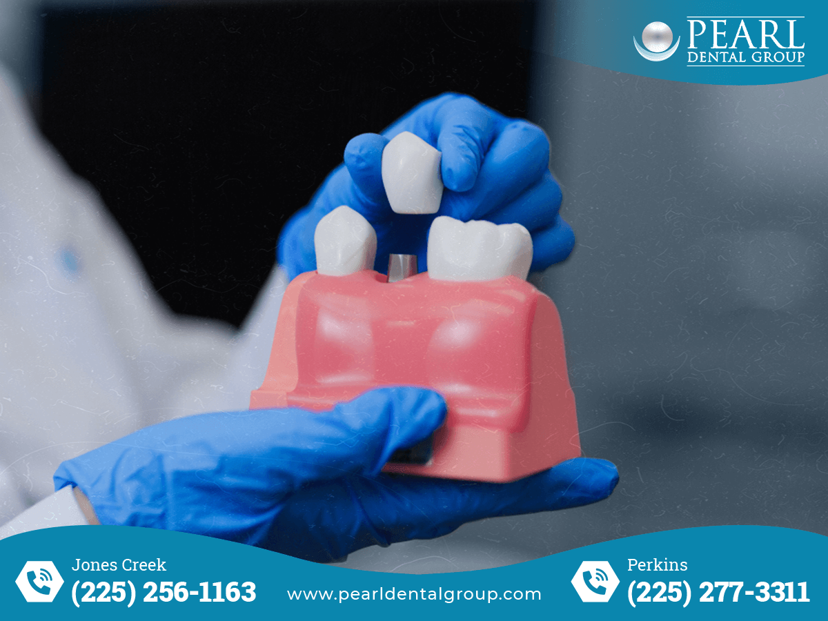 Best Dental Implants in Baton Rouge