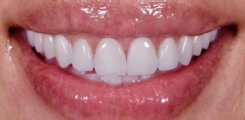 professional teeth whitening in Baton Rouge
