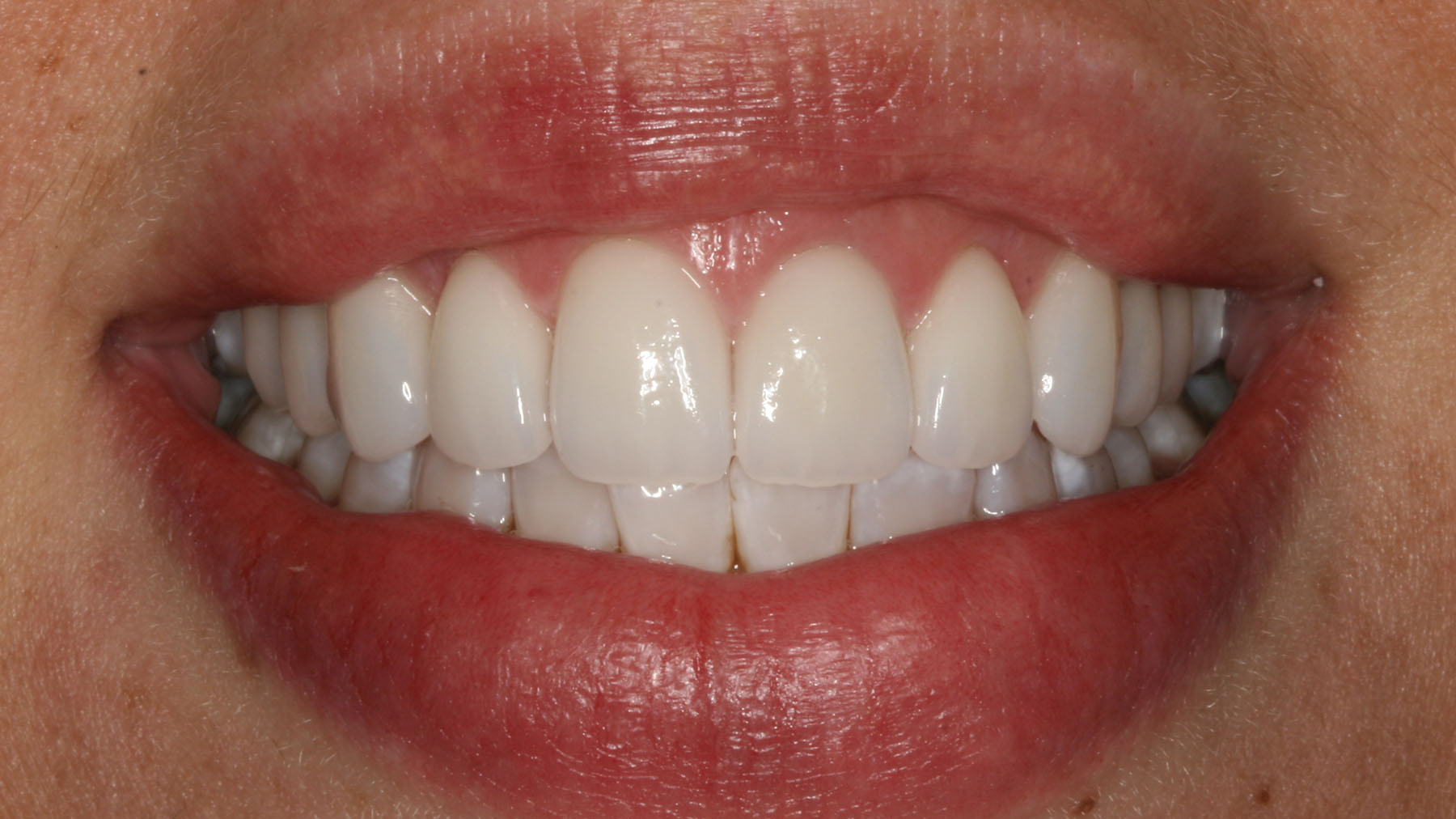 Teeth Whitening in Baton Rouge