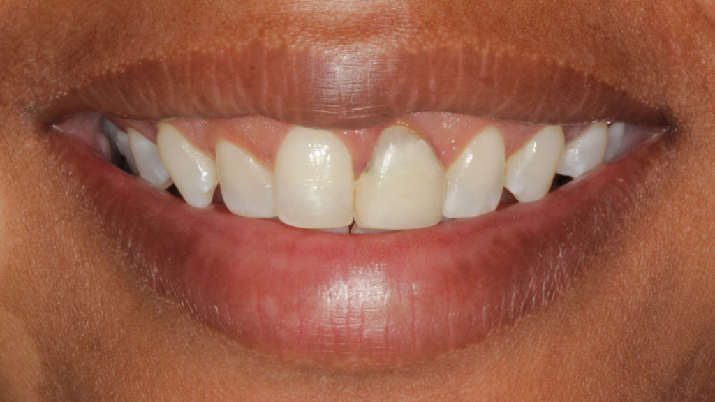 Invisalign in Baton Rouge