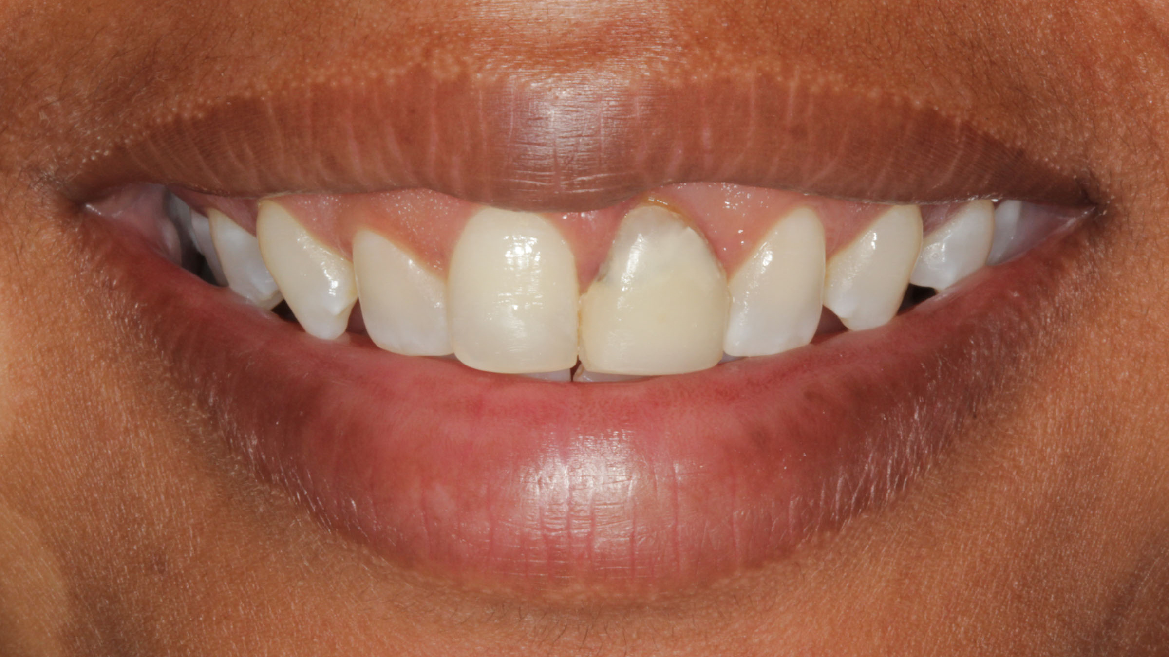 Invisalign in Baton Rouge