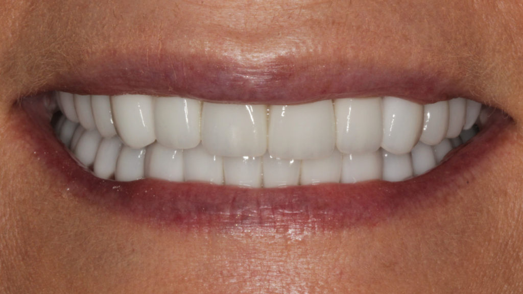 Professional Teeth Whitening in Baton Rouge