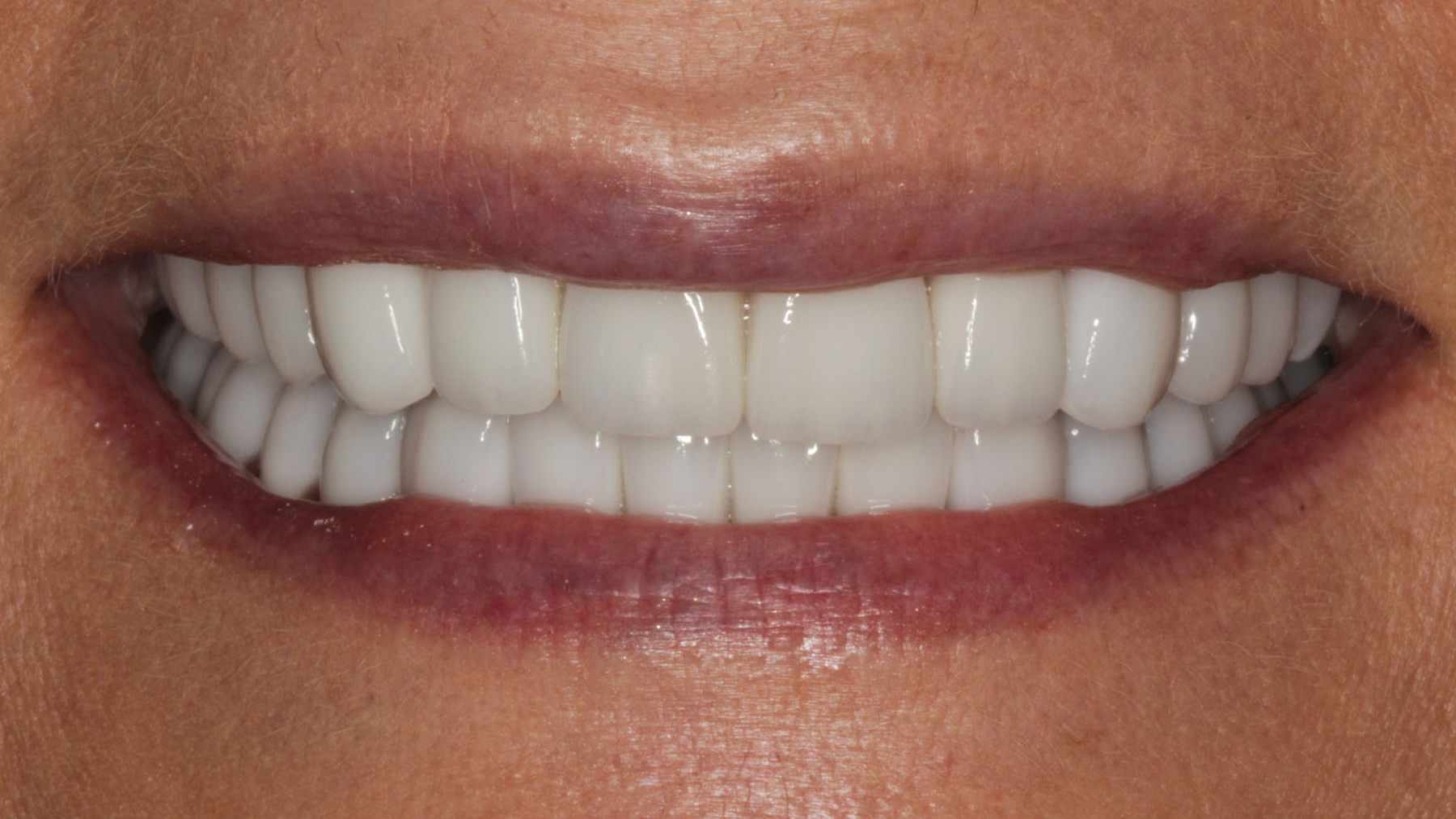 Professional Teeth Whitening in Baton Rouge