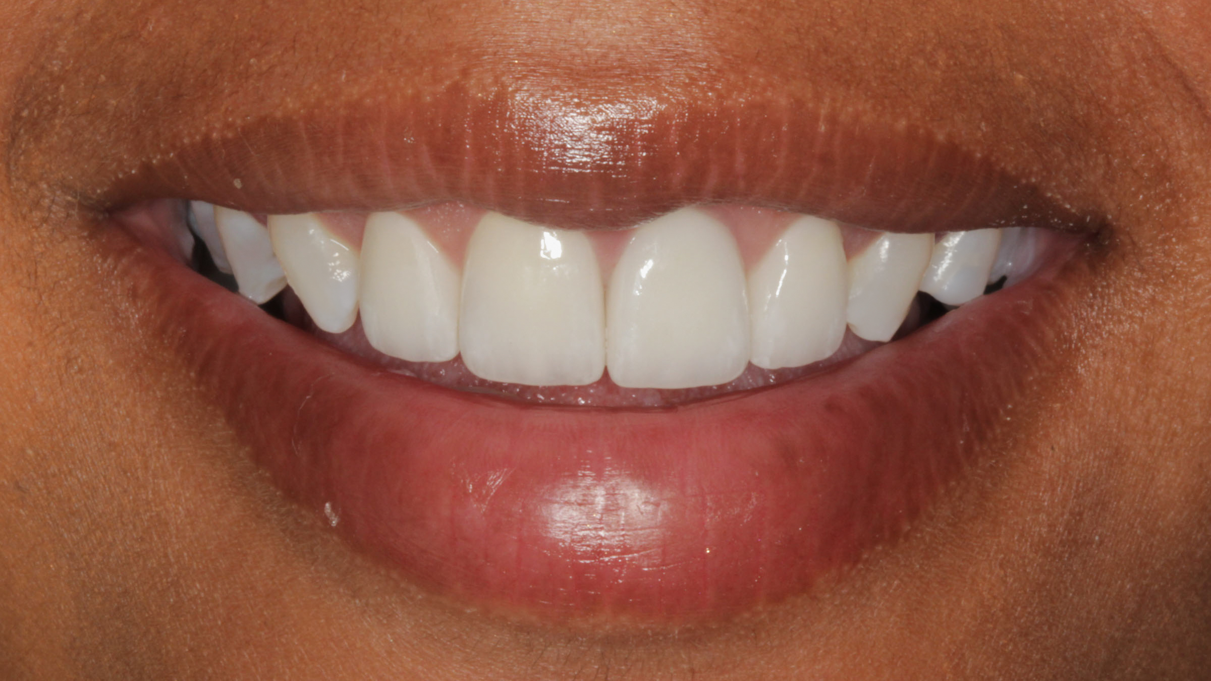 Sedation Dentistry in Baton Rouge