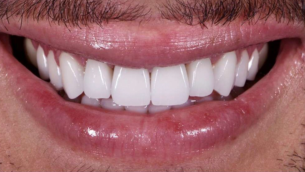 Dental Implant Prices in Baton Rouge