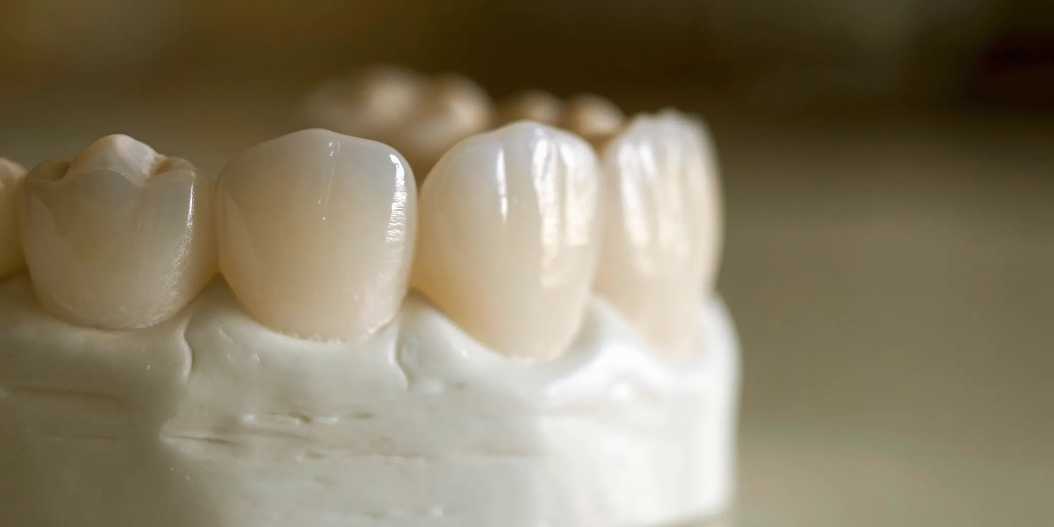 Porcelain veneers on a dental model.