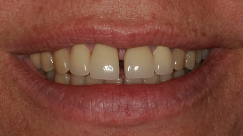 before-smile-1-1024x576