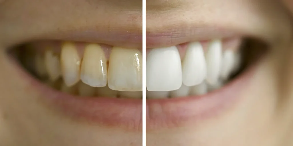 Full mouth veneers before and after, transforming yellowed teeth into a bright white smile.