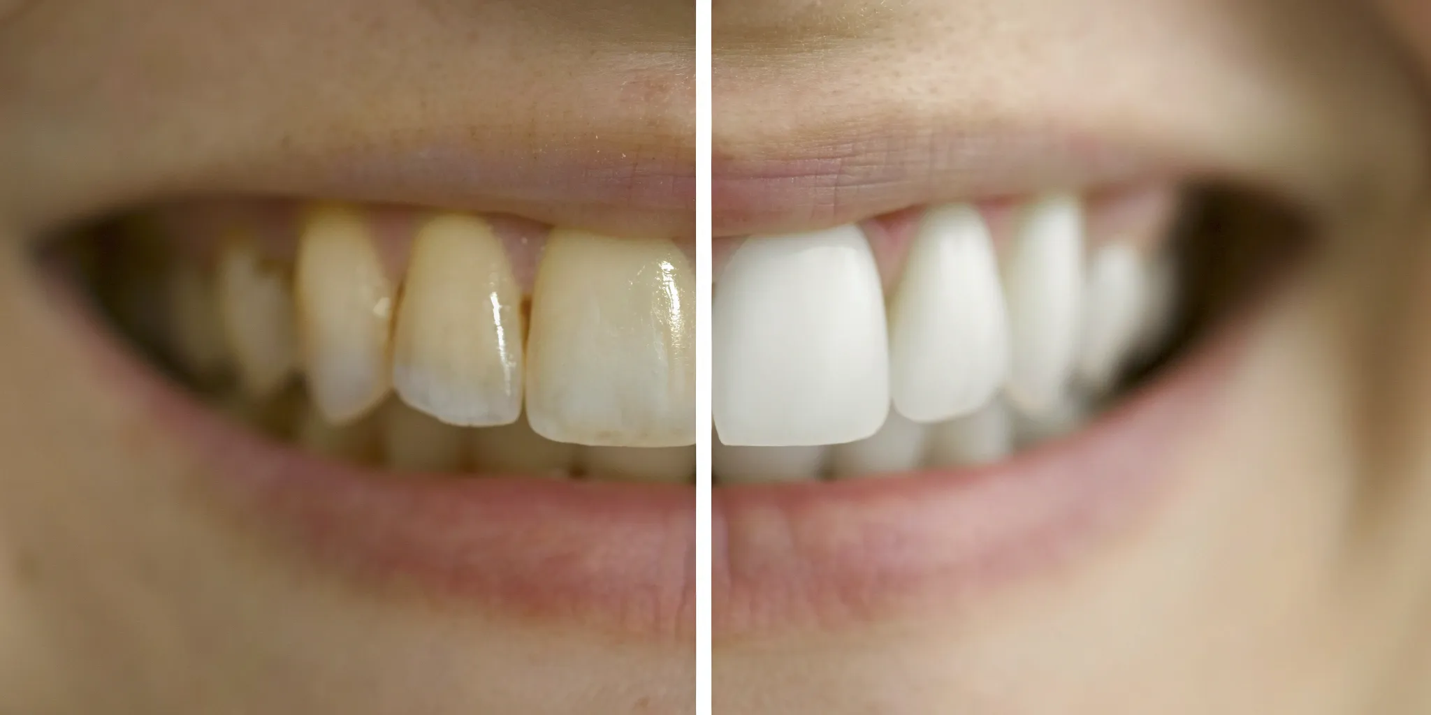 Full mouth veneers before and after, transforming yellowed teeth into a bright white smile.